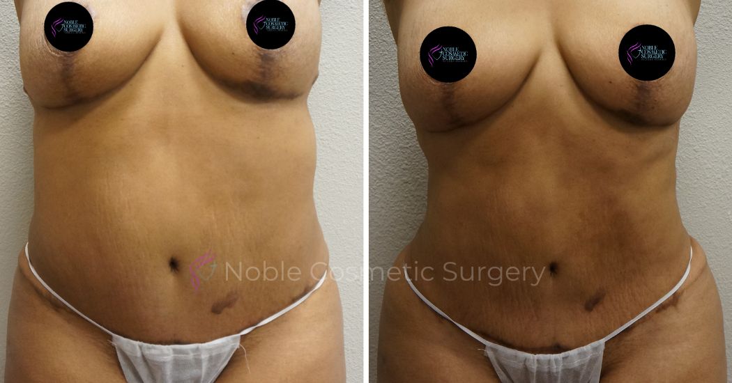 P40-00940L | Before and After Liposuction 1