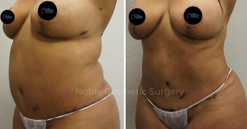 P40-00940L | Before and After Liposuction 2