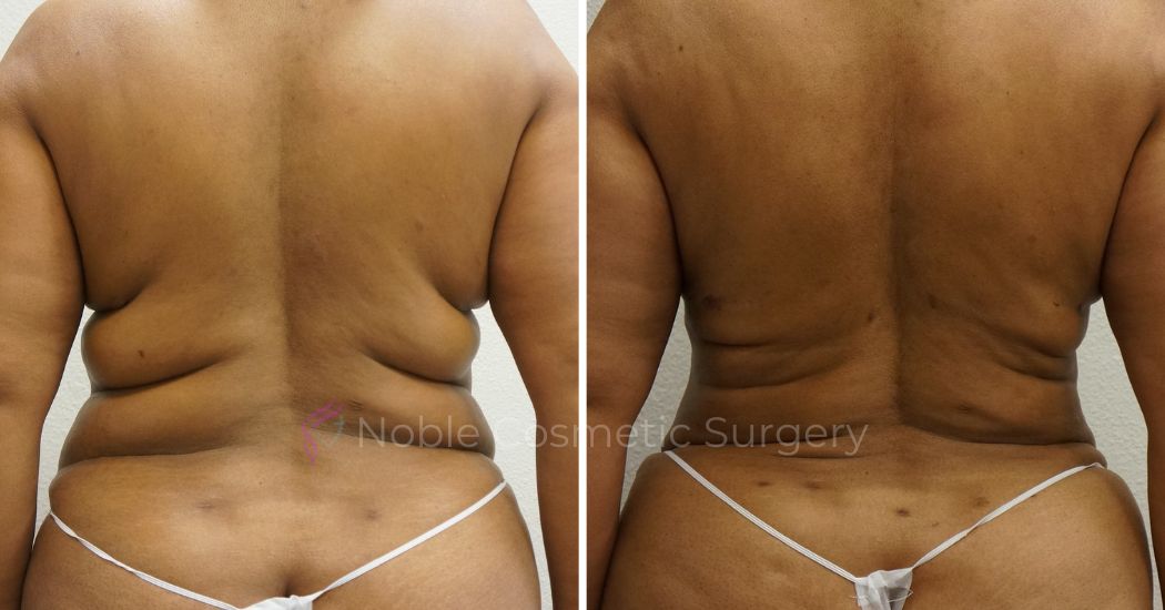P40-00940L | Before and After Liposuction 3