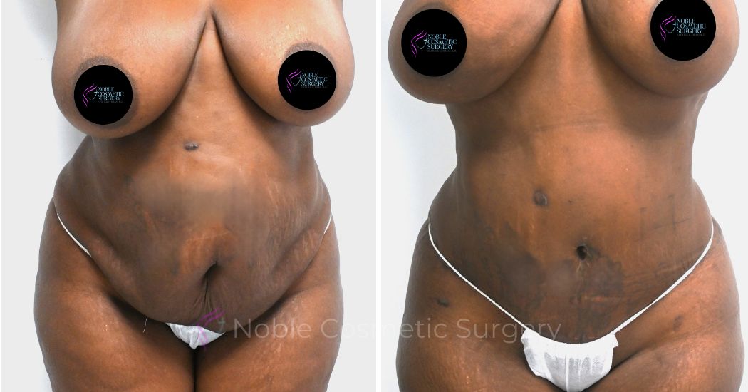P41-00323A | Before and After Abdominoplasty 1