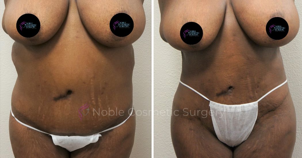 P41-00941L | Before and After Liposuction 1