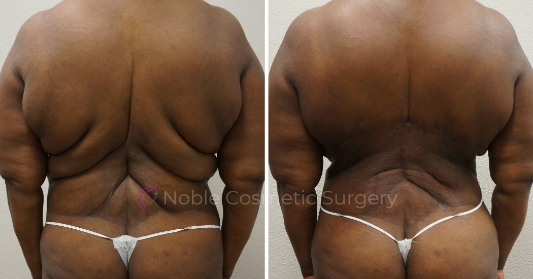 P41-00941L | Before and After Liposuction 3