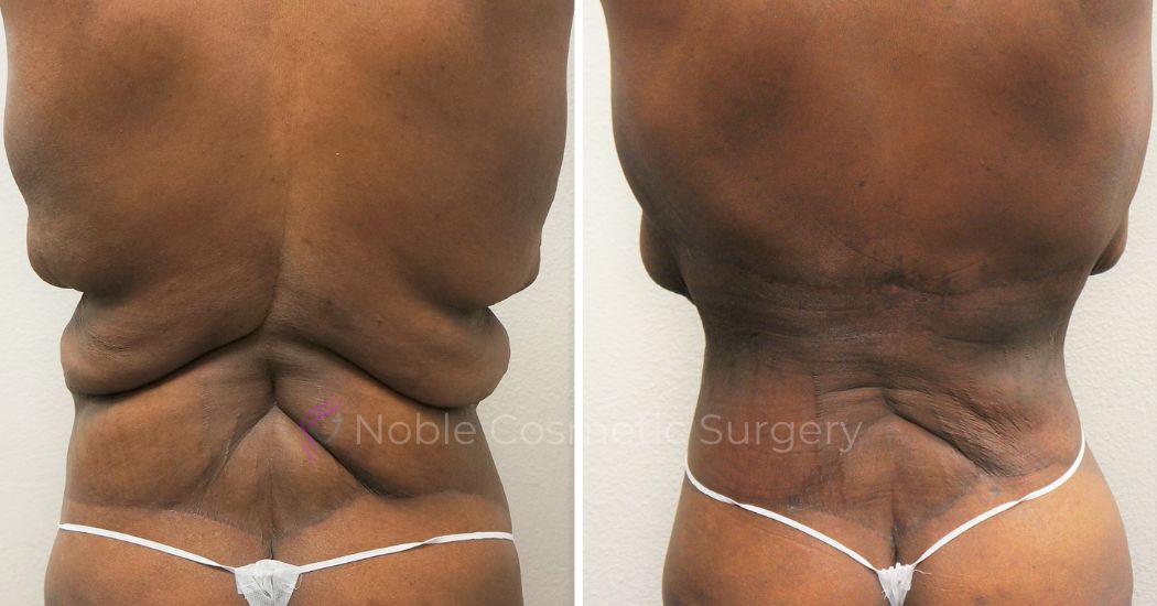 P41-00941L | Before and After Liposuction 4