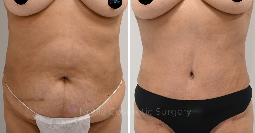 P42-00324A | Before and After Abdominoplasty 1