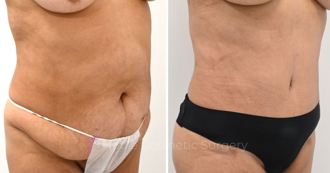P42-00324A | Before and After Abdominoplasty 2