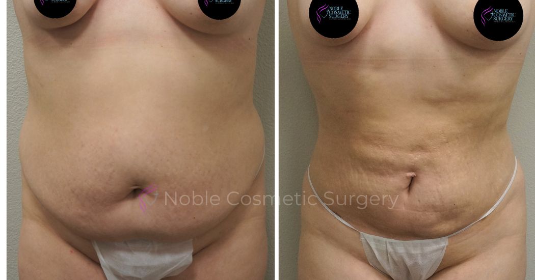 P42-00942L | Before and After Liposuction 1