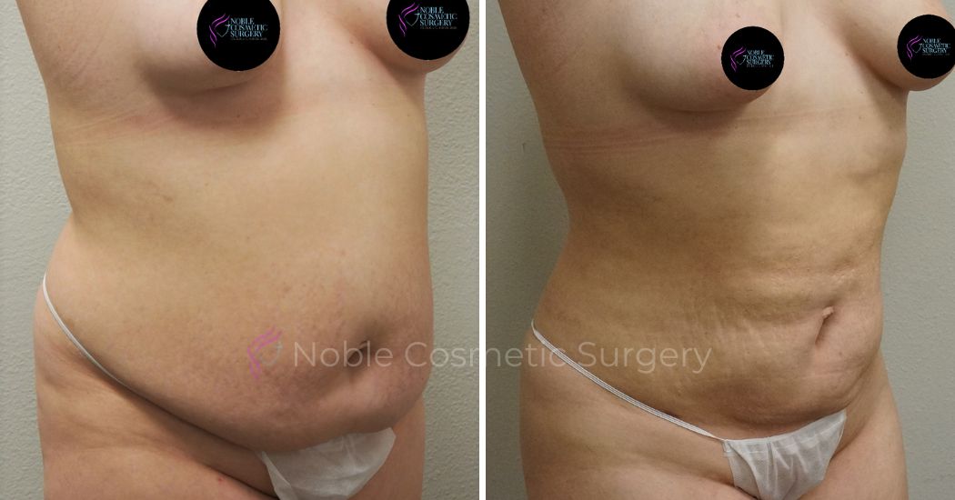 P42-00942L | Before and After Liposuction 2