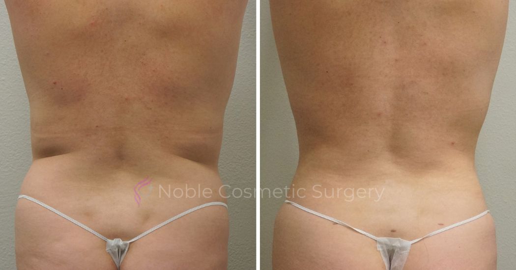 P42-00942L | Before and After Liposuction 3