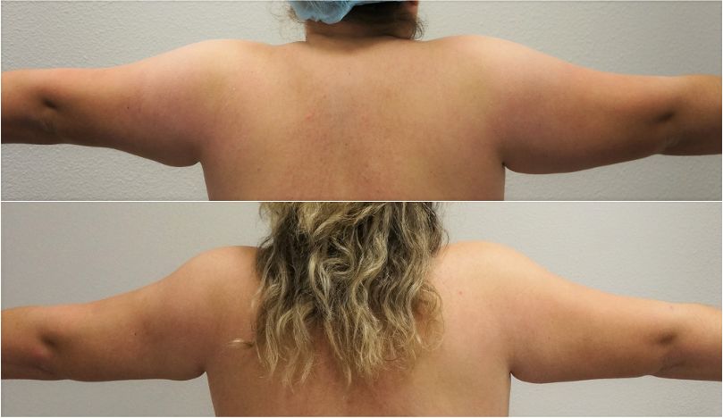 P42-00942L | Before and After Liposuction 4