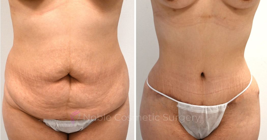 P43-00325A | Before and After Abdominoplasty 1