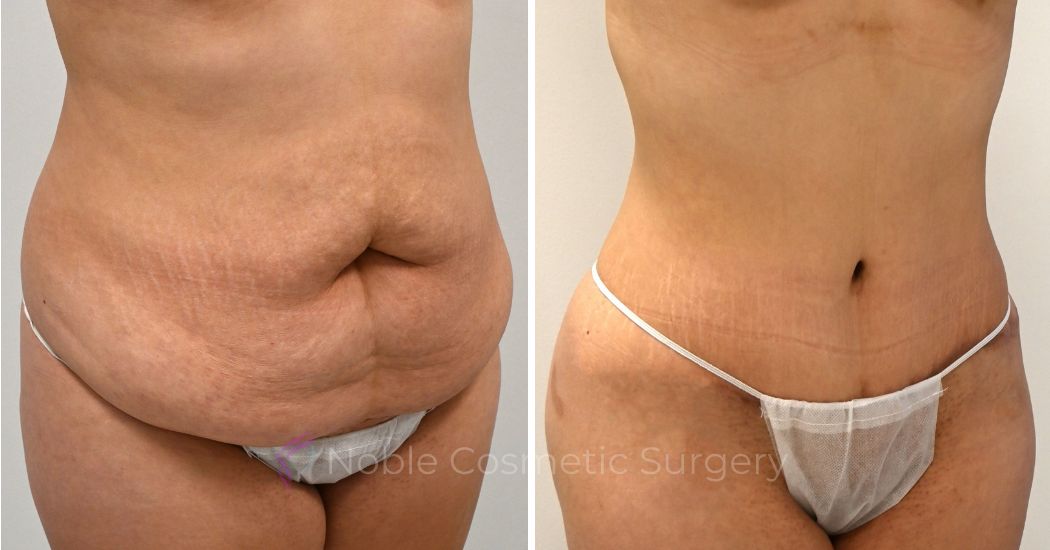 P43-00325A | Before and After Abdominoplasty 2