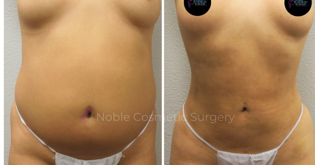 P43-00943L | Before and After Liposuction 1