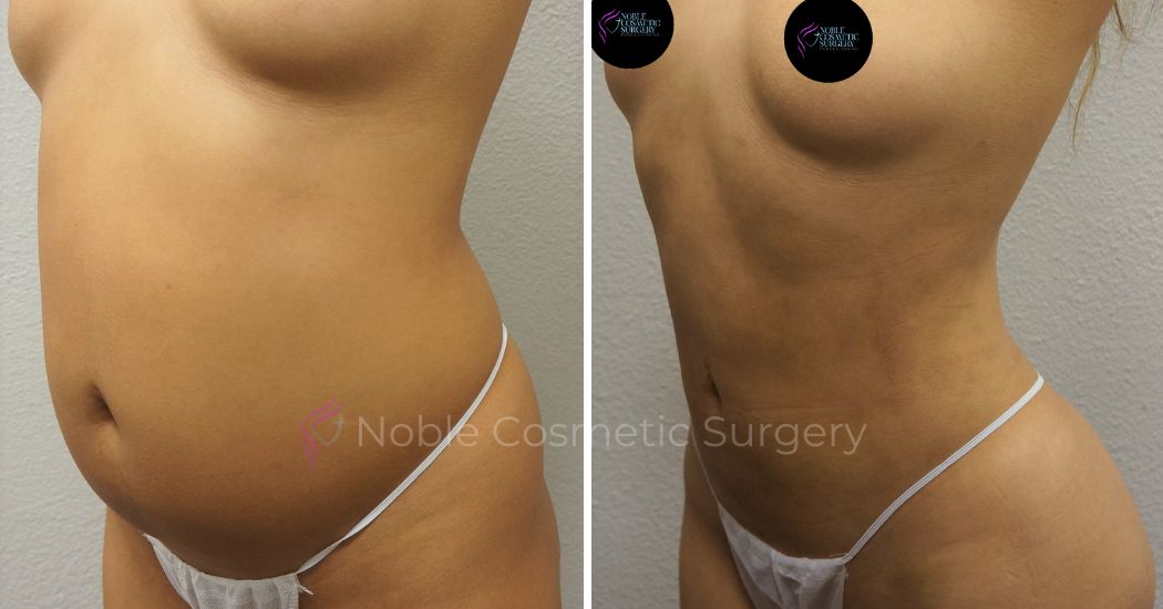 P43-00943L | Before and After Liposuction 2