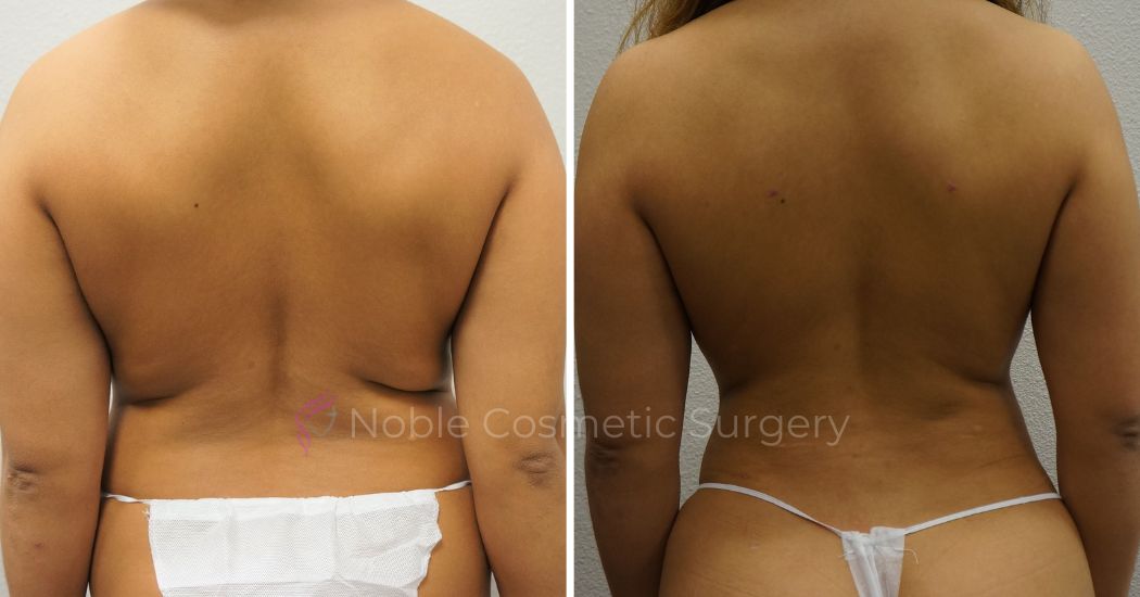 P43-00943L | Before and After Liposuction 3