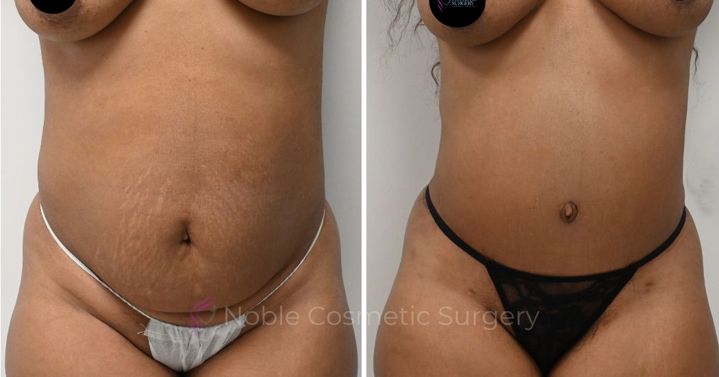 P44-00326A | Before and After Abdominoplasty 1