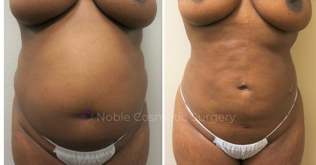 P44-00944L | Before and After Liposuction 1