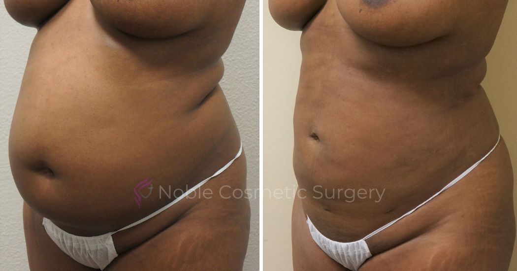 P44-00944L | Before and After Liposuction 2