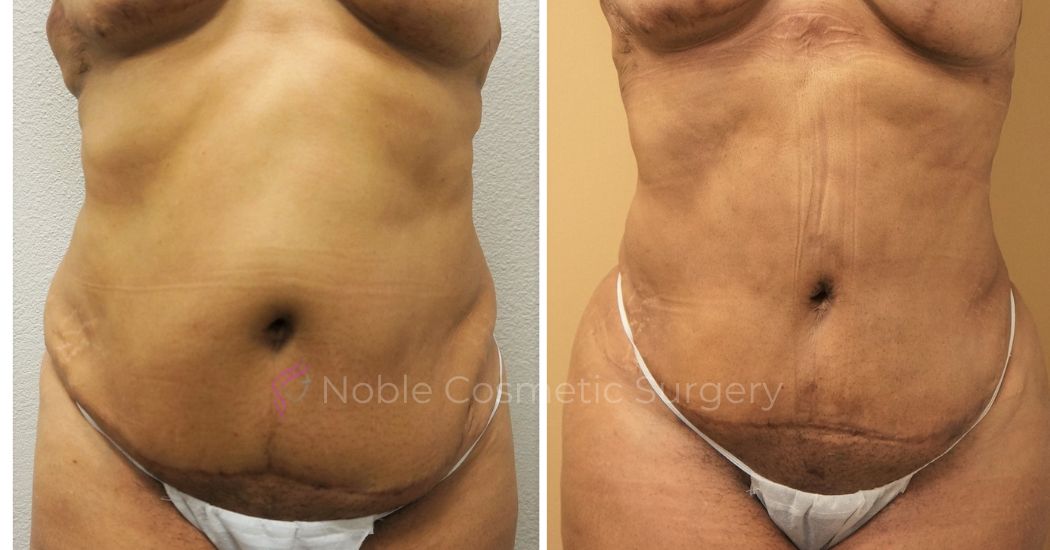 P45-00945L | Before and After Liposuction 1