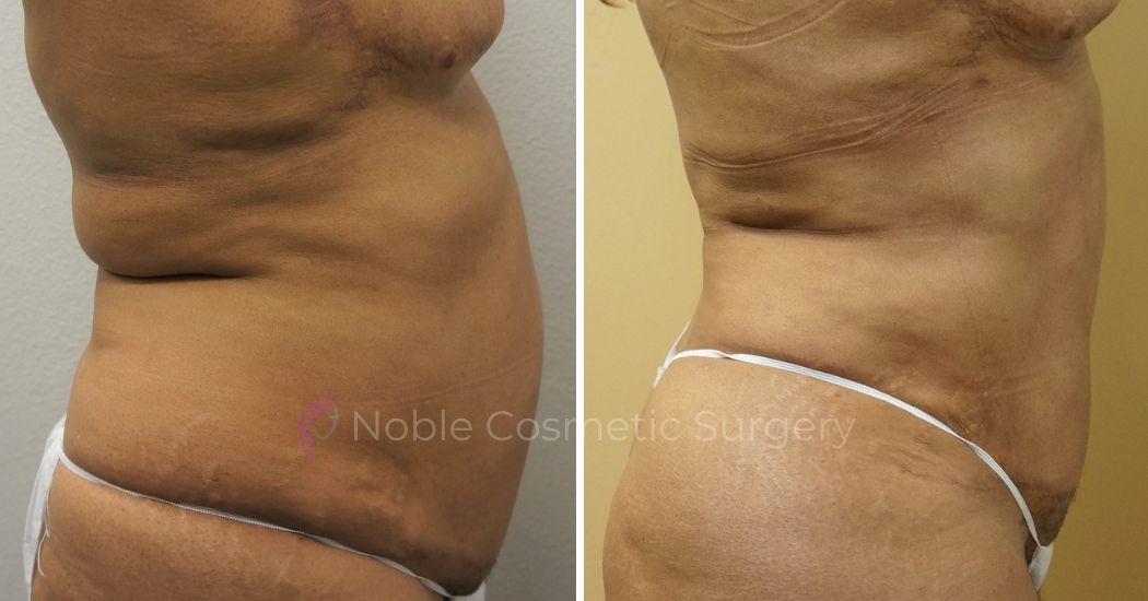 P45-00945L | Before and After Liposuction 2