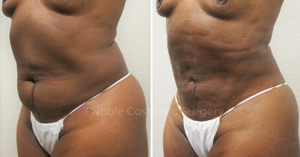 P46-00946L | Before and After Liposuction 2