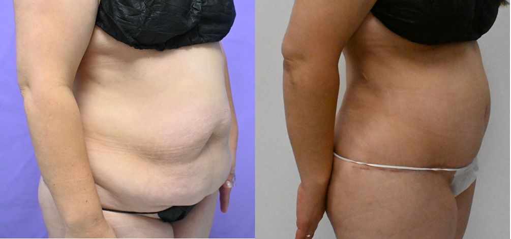 P46-19828A | Before and After Abdominoplasty 2
