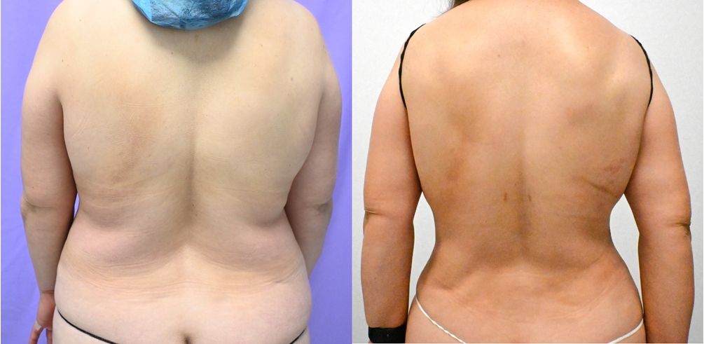 P46-19828A | Before and After Abdominoplasty 4