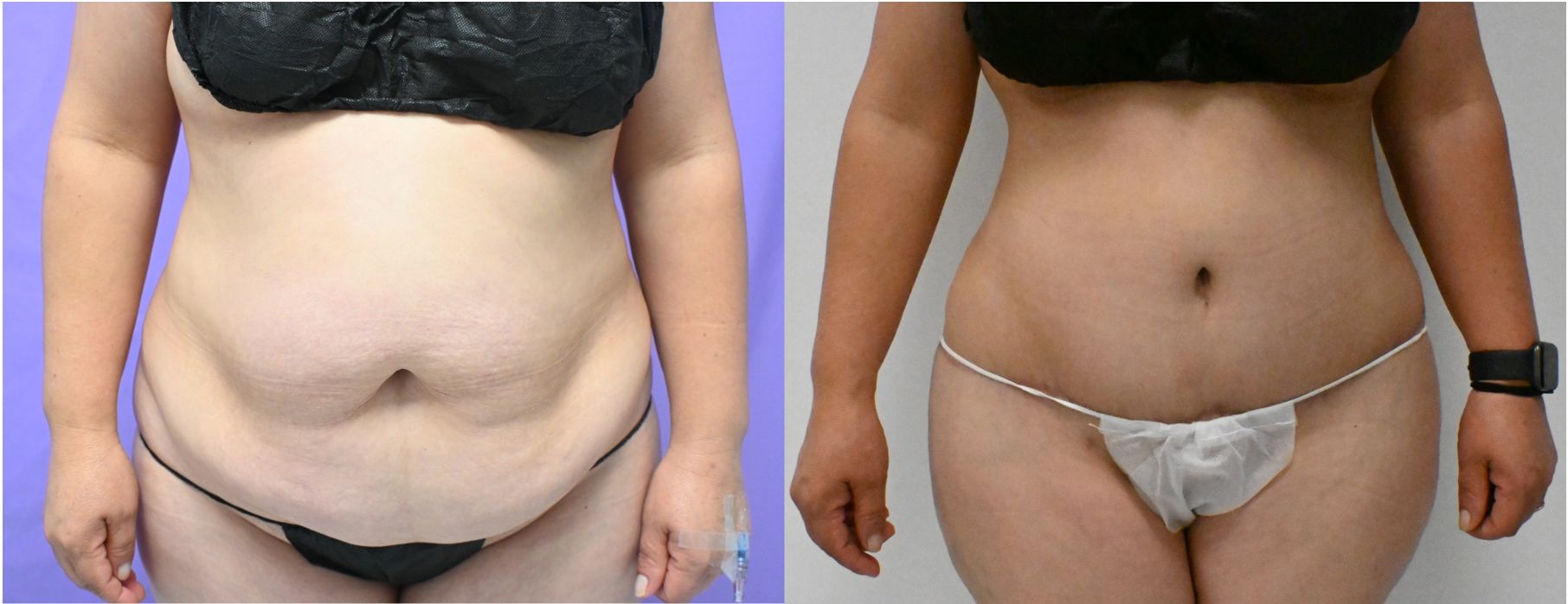 P46-19828A | Before and After Abdominoplasty 1