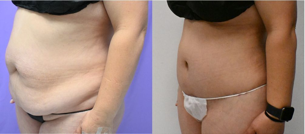 P46-19828A | Before and After Abdominoplasty 3