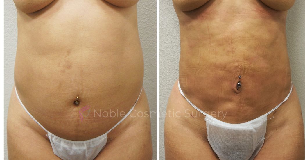 P47-00947L | Before and After Liposuction 1
