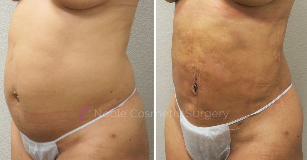 P47-00947L | Before and After Liposuction 2
