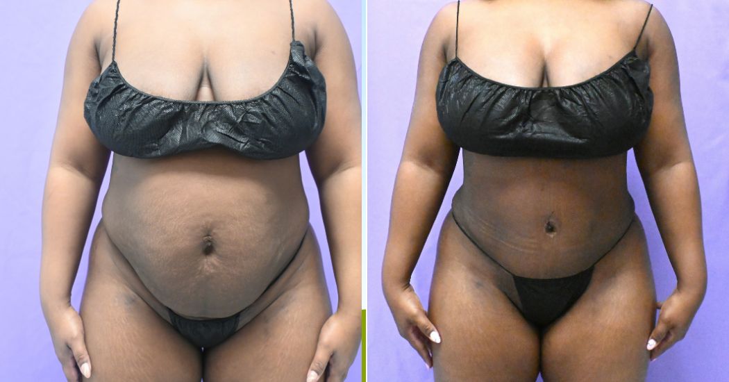 P47--10172A | Before and After Abdominoplasty 1