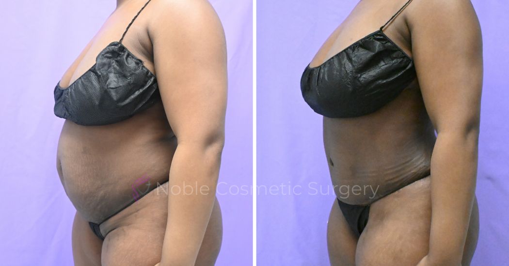 P47--10172A | Before and After Abdominoplasty 2