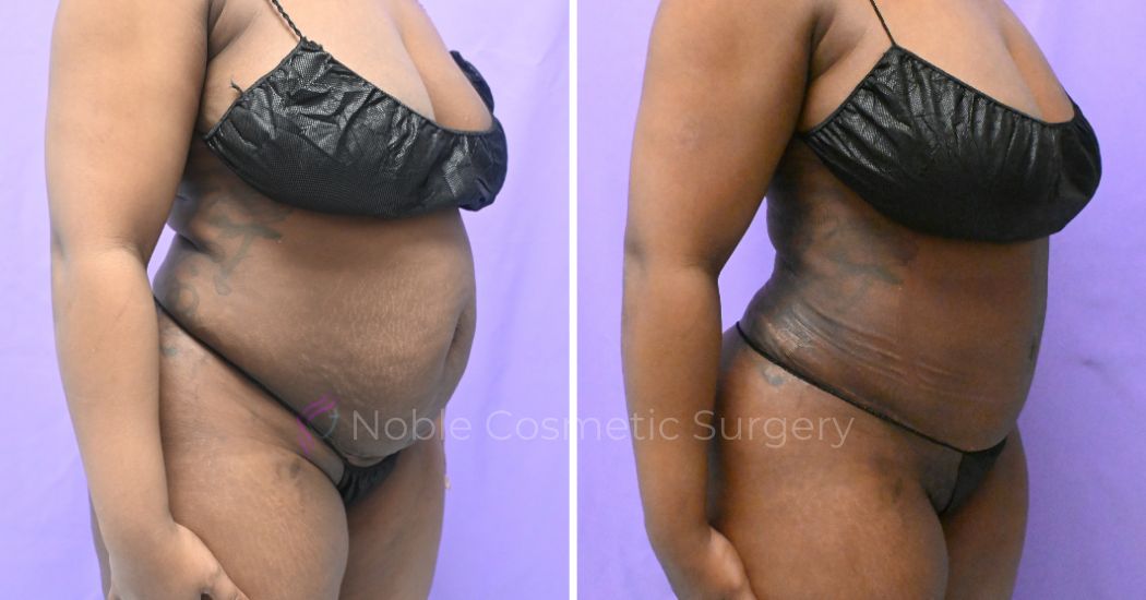 Tummy Tuck 47