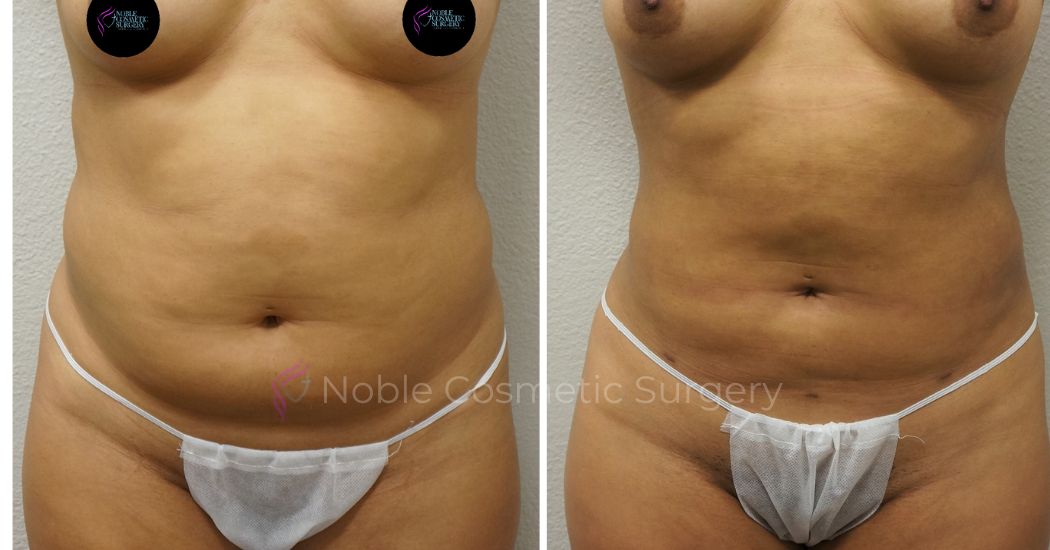 P48-00948L | Before and After Liposuction 1