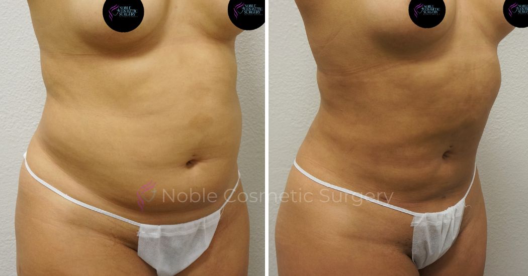 P48-00948L | Before and After Liposuction 2