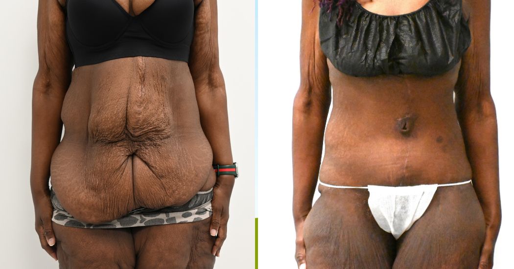 P48--19680A | Before and After Abdominoplasty 1