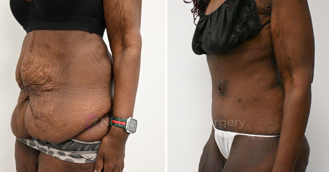 P48--19680A | Before and After Abdominoplasty 2