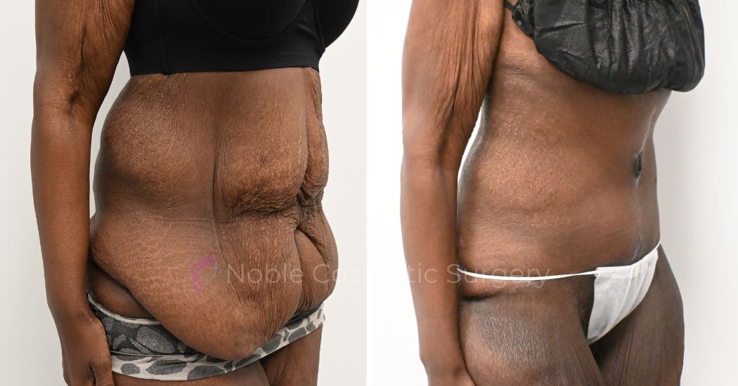 Tummy Tuck 48