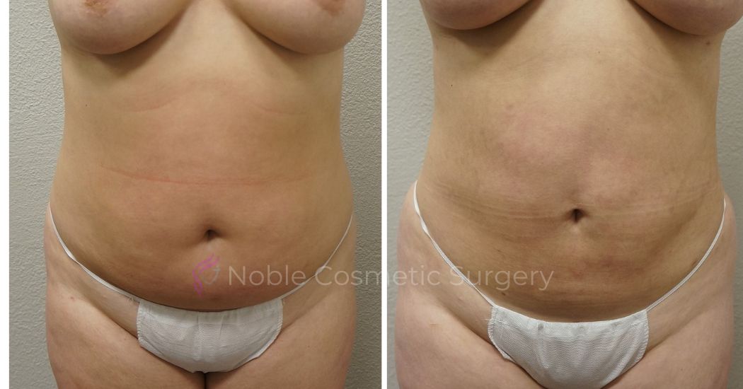 P49-00949L | Before and After Liposuction 1