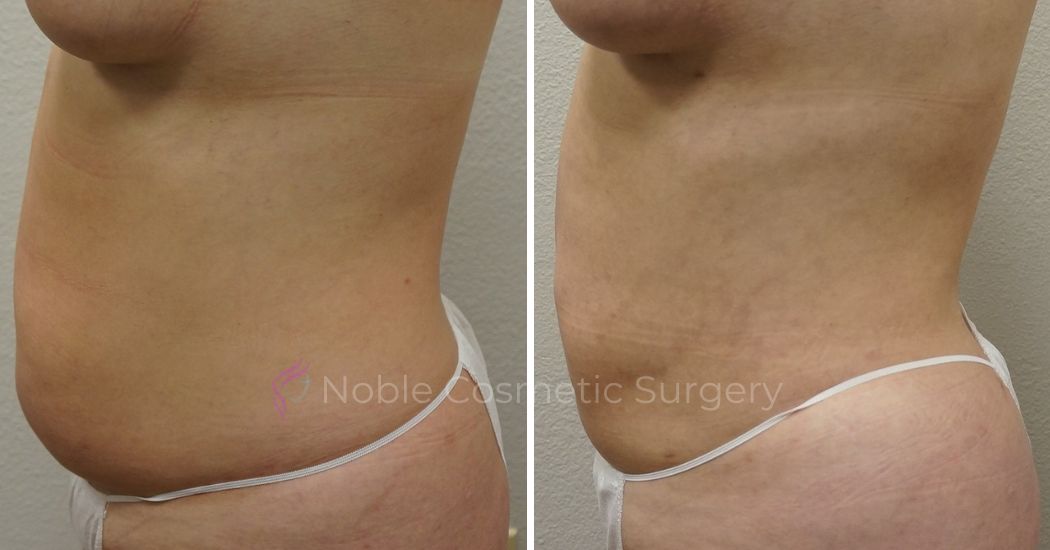 P49-00949L | Before and After Liposuction 2
