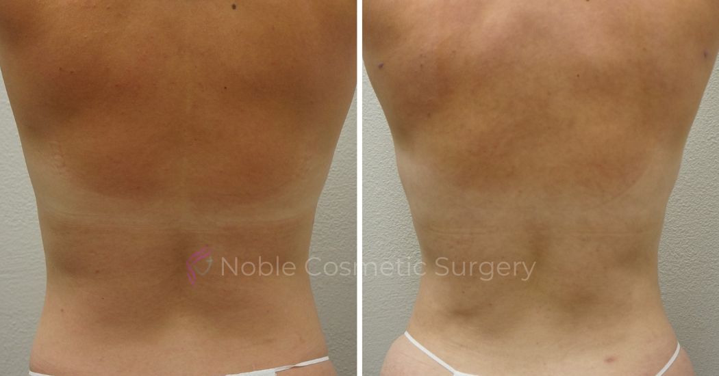P49-00949L | Before and After Liposuction 3