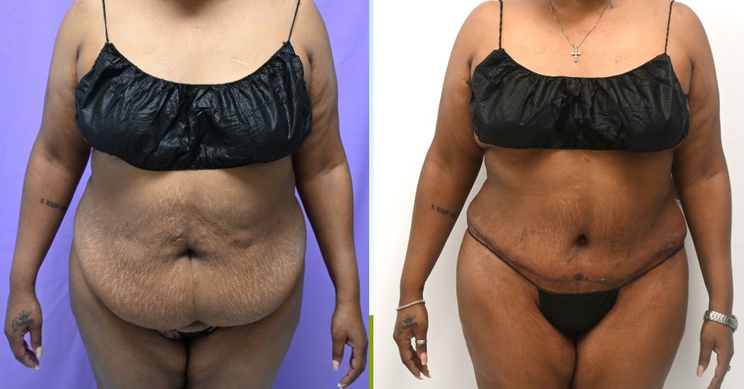 P49-12161A | Before and After Abdominoplasty 1