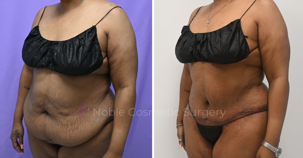 P49-12161A | Before and After Abdominoplasty 2