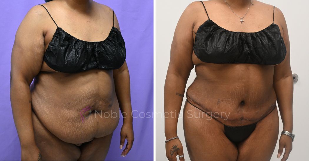 P49-12161A | Before and After Abdominoplasty 3