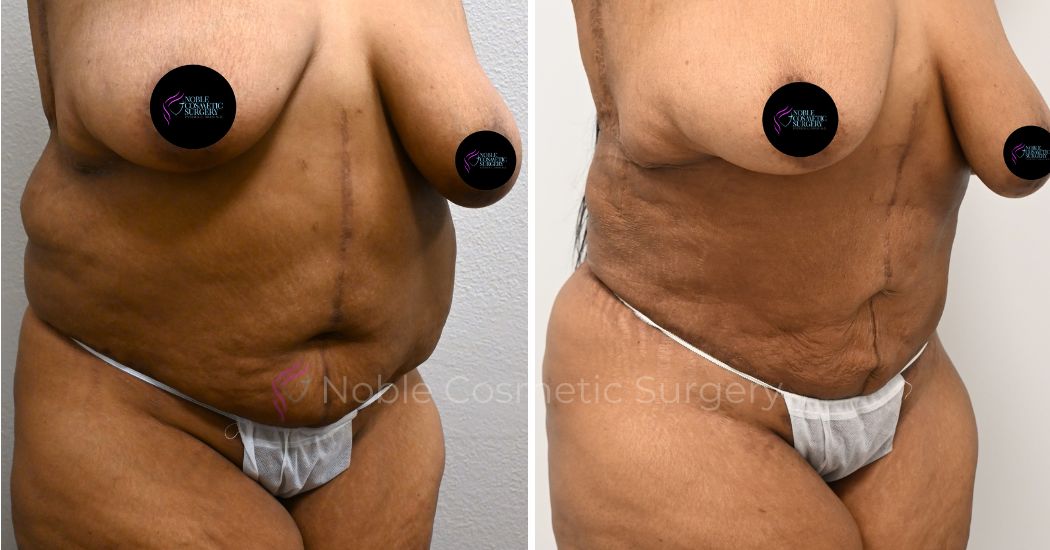 P5-00036A | Before and After Abdominoplasty 2