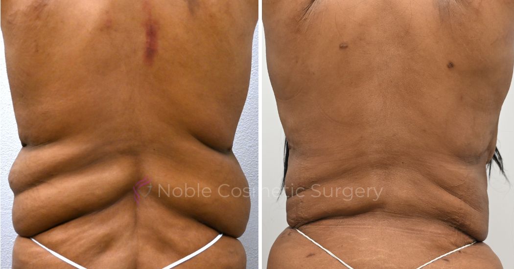 P5-00036A | Before and After Abdominoplasty 3