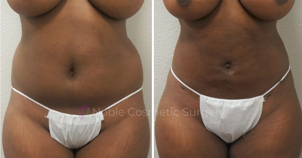 P5-00905L | Before and After Liposuction 1
