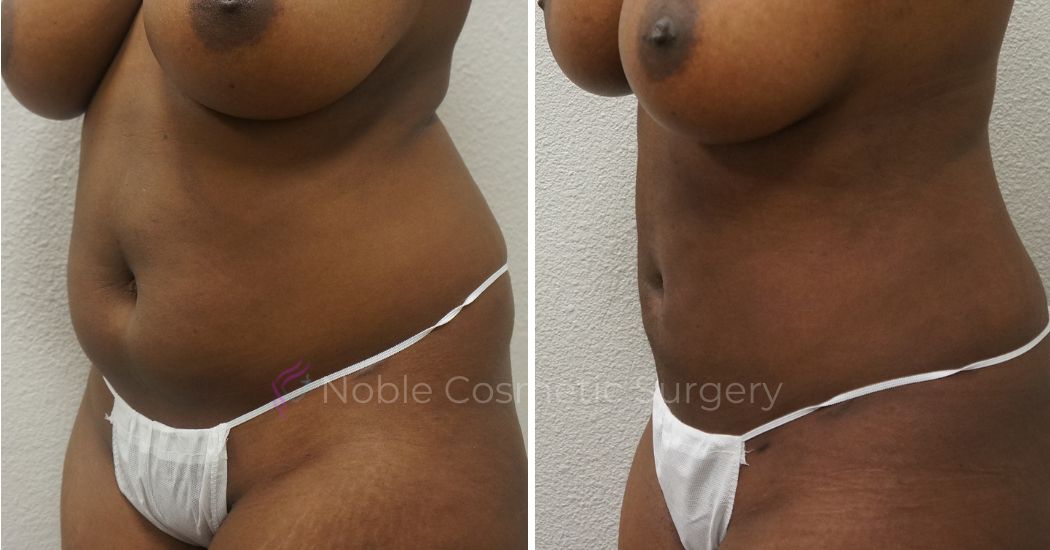 P5-00905L | Before and After Liposuction 2