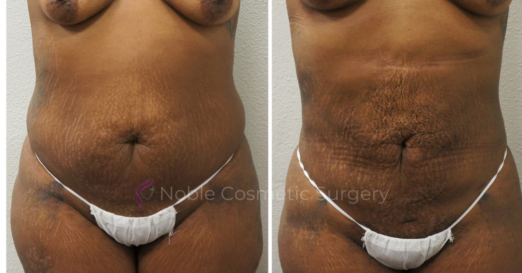 P50-00950L | Before and After Liposuction 1