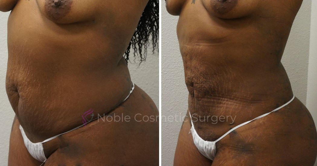 P50-00950L | Before and After Liposuction 2